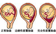 前置胎盤分哪幾種？有什么癥狀？